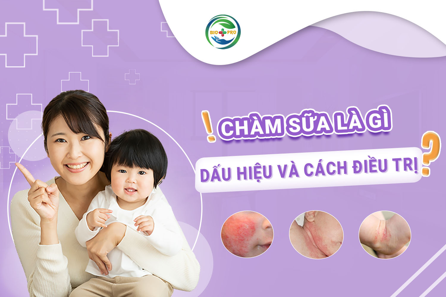 Chàm sữa là gì? Dấu hiệu và cách điều trị