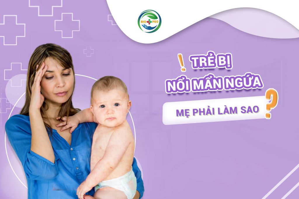 Trẻ bị nổi mẩn ngứa mẹ phải xử lý sao?
