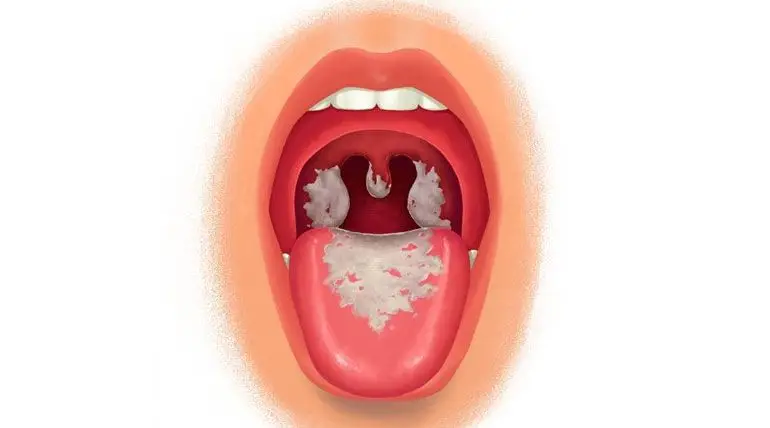 Bệnh bạch hầu và các biện pháp phòng tránh Dưới ánh sáng mặt trời trực tiếp, vi khuẩn bạch hầu sẽ bị chết sau vài giờ