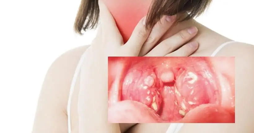 Bệnh bạch hầu và các biện pháp phòng tránh Bệnh bạch hầu có triệu chứng điển hình như sốt nhẹ, ho, khàn tiếng, đau họng