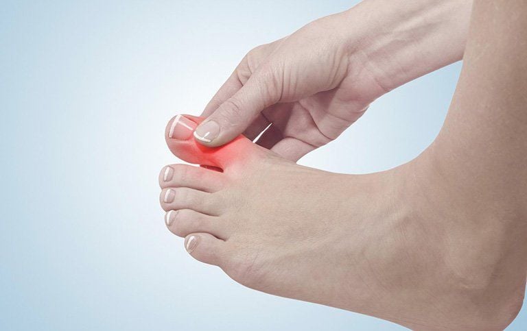 Bệnh gút: Những điều bạn cần biết Bệnh Gút chỉ tình trạng viêm khớp do sự tích tụ axit uric gây ra.