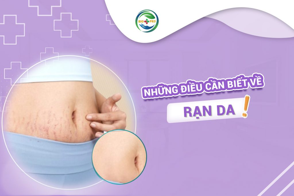 Những điều cần biết về rạn da