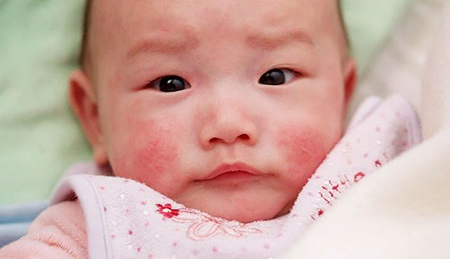 Trẻ bị sởi cần chăm sóc như thế nào? Ban dát hồng, hơi gờ lên mặt da, mịn là một trong những biểu hiện của trẻ bị sởi