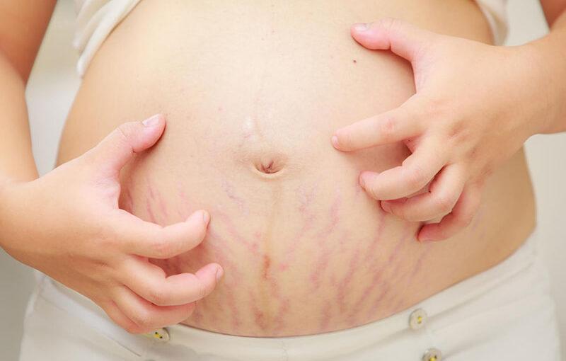 Những điều cần biết về rạn da Mẹ mang thai rất dễ gặp tình trạng rạn da