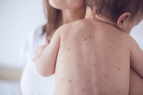 Bệnh thuỷ đậu là gì? Những điều cần biết về bệnh Thủy đậu lây lan chủ yếu qua đường hô hấp