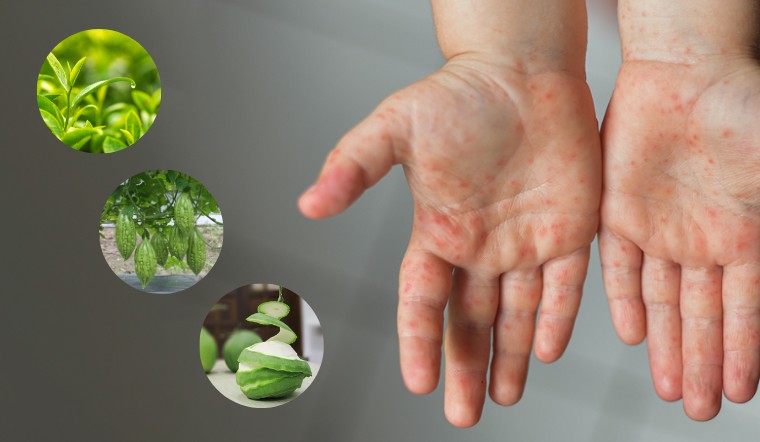 Trẻ bị sởi cần chăm sóc như thế nào? Trẻ bị sởi cần tắm với những loại lá lành để tránh mẩn ngứa thêm