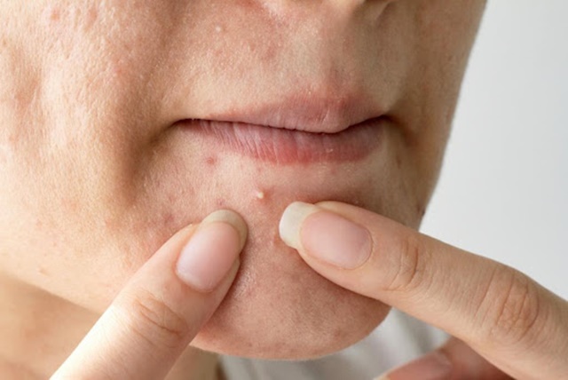Uống gì để mát gan hết mụn? Mụn do nóng gan có đầu trắng, mọc li ti