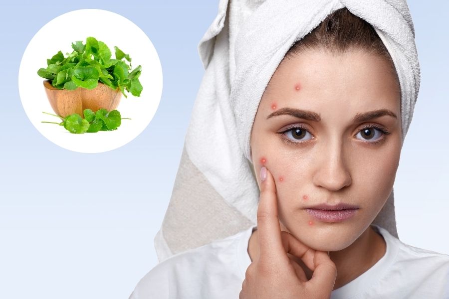 Công dụng của rau má và những lưu ý khi sử dụng Rau má giúp giảm mụn nhọt rất hiệu quả