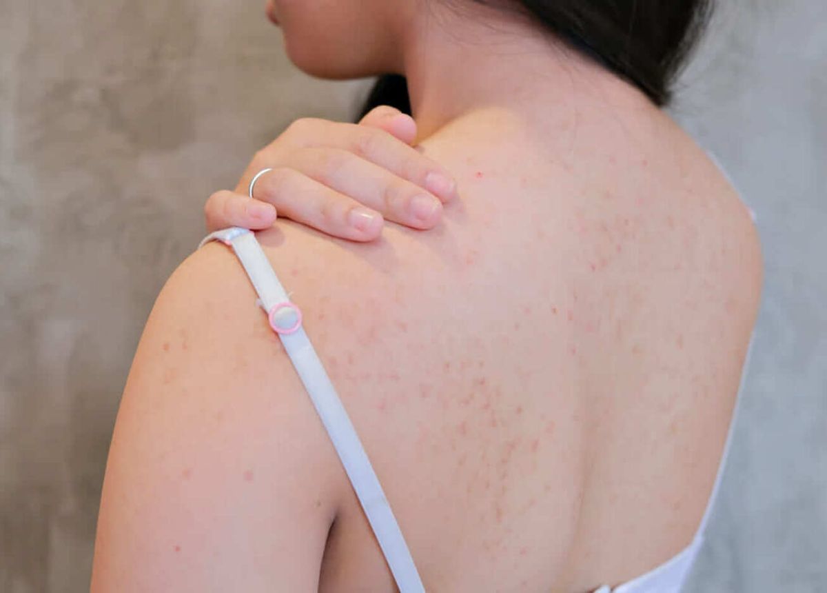 Gai bồ kết - Tiêu thũng trừ độc giảm mủ nhọt mun lung