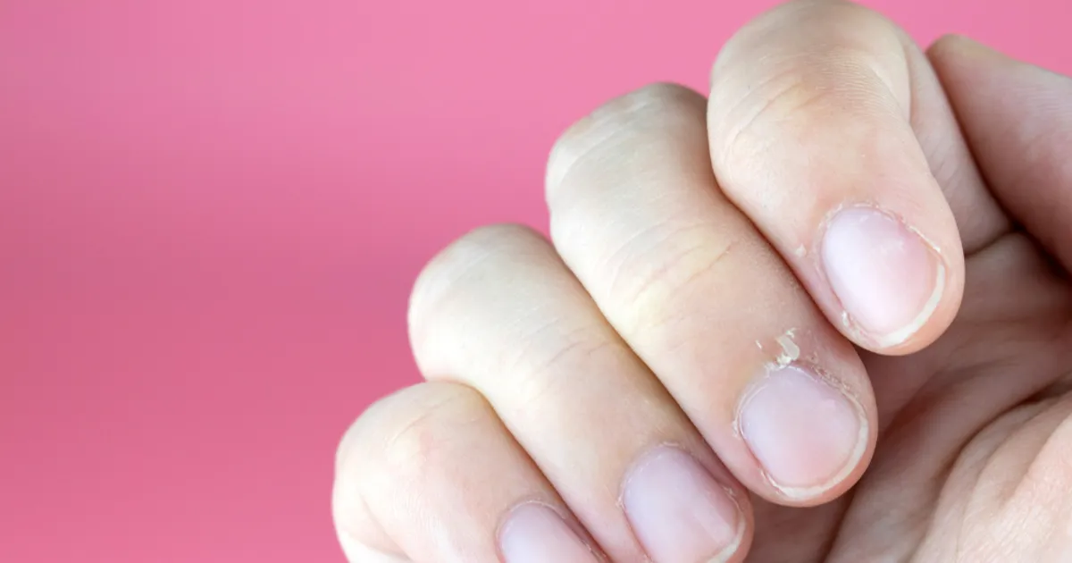 Xước Măng Rô: 5 Nguyên Nhân, Cách Phòng Ngừa và Cải Thiện Xuoc mang ro